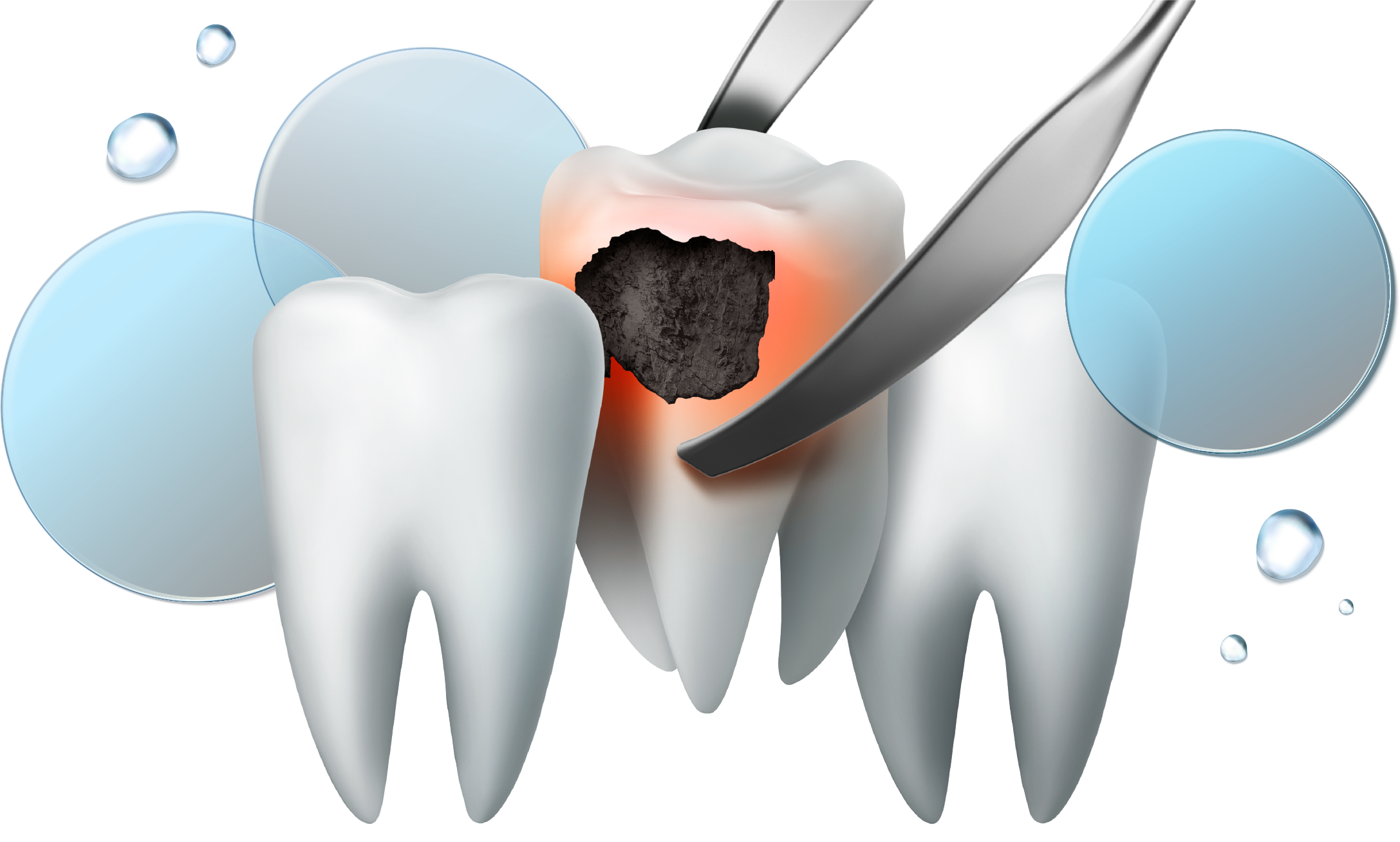 스케일링 발치 보장